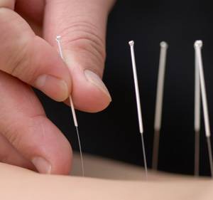                   Acupuncture is one of our treatment specialties